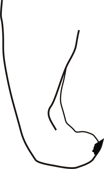 Adeclus trispinosus Cadena-Castañeda, 2011: reproduced with permission. male cercus, dorsal view. (Otu).