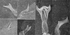 Other: !! display not done !! on Erasmoneura vulnerata (Fitch, 1851): Pygofer lobe, aedeagus, connective, and styli. (Observation).