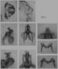 Melanoplus borealis (Fieber, 1853): male genitalia. (Otu).