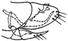 Pygofer, lateral view: !! display not done !! on Graminella sonora (Ball, 1900): genital capsule, laterally. (Observation).