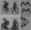 Melanoplus borealis (Fieber, 1853): male genitalia. (Otu).