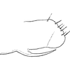 Pygofer, lateral view on Asymmetrasca decedens (Paoli, 1932): Genital capsule, lateral view. (Observation).